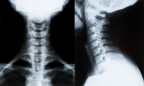 neck-x-ray